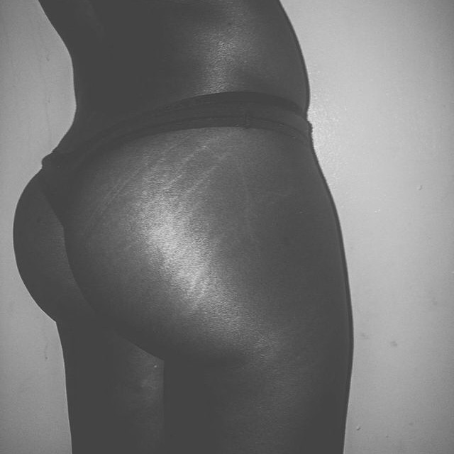 Instagram: #loveyourlines Ama Il Tuo Corpo, Imperfezioni Comprese!