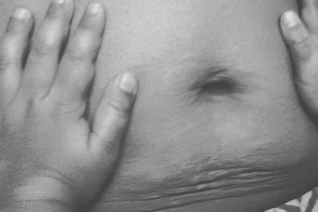 Instagram: #loveyourlines Ama Il Tuo Corpo, Imperfezioni Comprese!