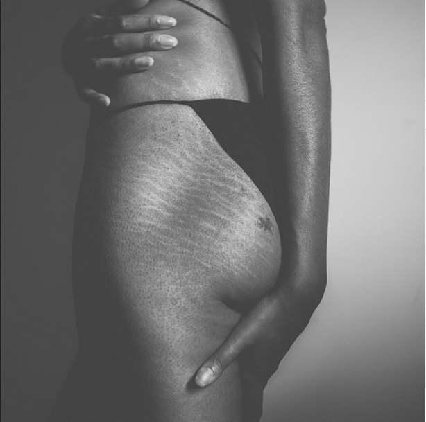 Instagram: #loveyourlines Ama Il Tuo Corpo, Imperfezioni Comprese!