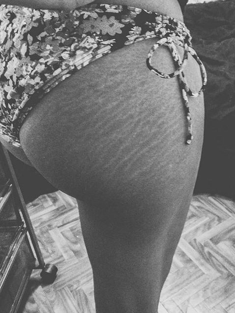 Instagram: #loveyourlines Ama Il Tuo Corpo, Imperfezioni Comprese!