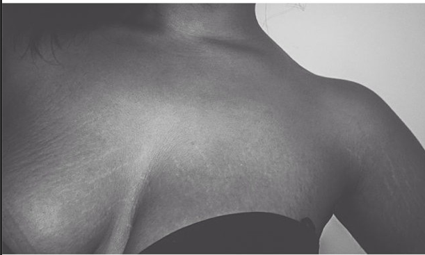 Instagram: #loveyourlines Ama Il Tuo Corpo, Imperfezioni Comprese!