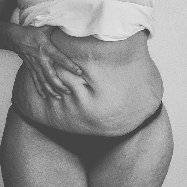 Instagram: #loveyourlines Ama Il Tuo Corpo, Imperfezioni Comprese!