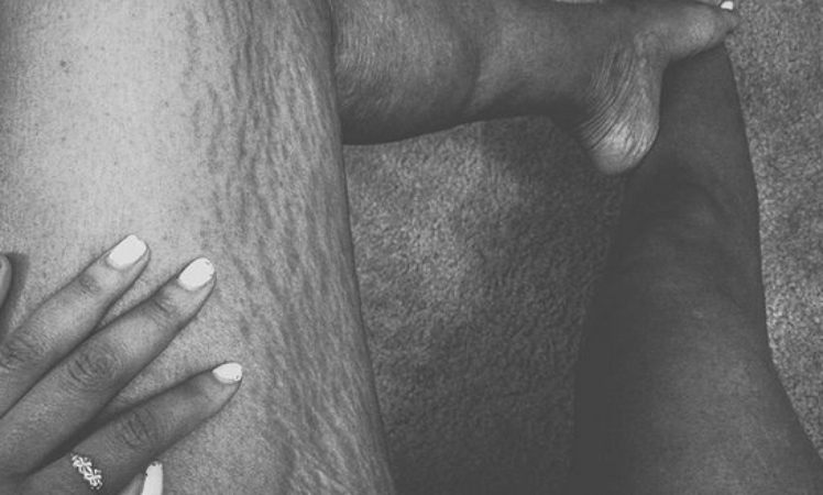 Instagram: #loveyourlines Ama Il Tuo Corpo, Imperfezioni Comprese!