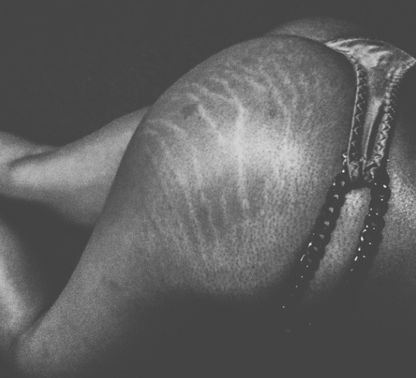 Instagram: #loveyourlines Ama Il Tuo Corpo, Imperfezioni Comprese!