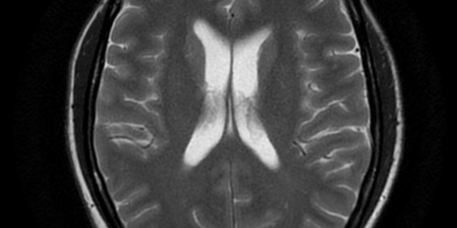 smartphone e tumori al cervello
