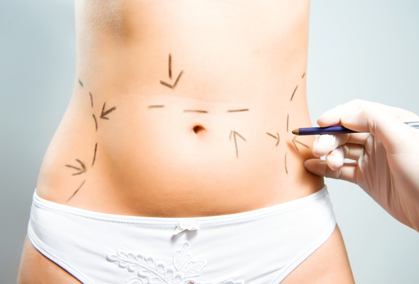 come funziona liposcultura