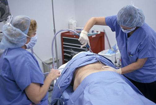 liposcultura, liposuzione, lipoaspirazione