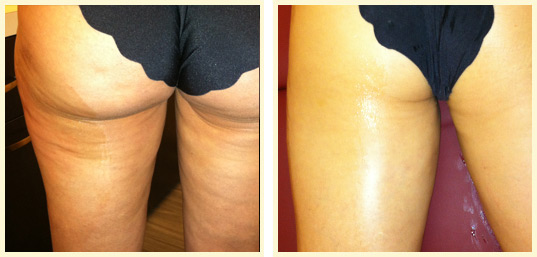 Conosciamo la liposcultura, l’evoluzione della liposuzione