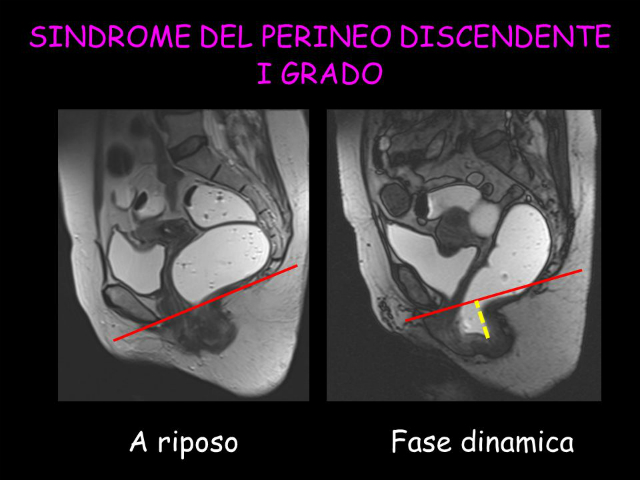 sindrome perineo discendente
