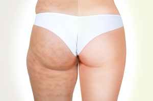 cellulite-fesse-300x199