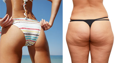 get-rid-of-cellulite